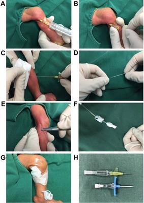 Application of epicutaneo-cava catheters with 24G indwelling needles in very low birth weight infants: a safe and simple innovative technique